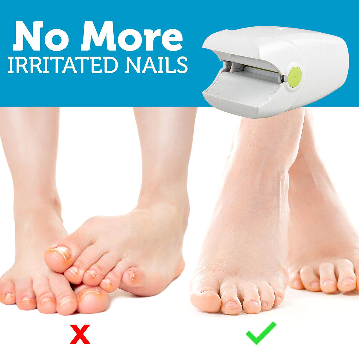 Revolutionary Toe And Fingernail Nail Fungus Home Remedies Treatment Laser Device